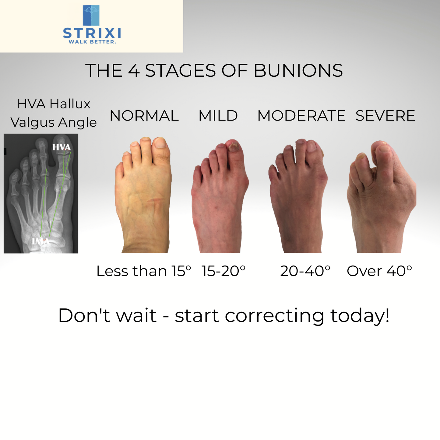 Bunion Corrector