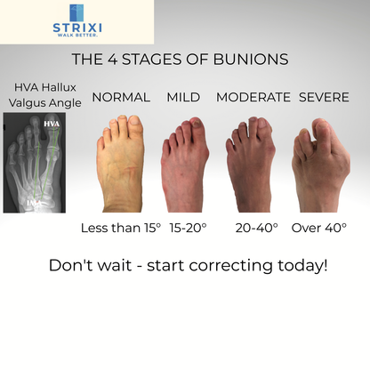 Bunion Corrector