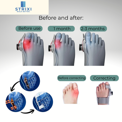 Bunion Corrector